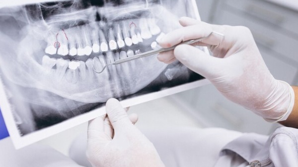 Pesquisa realizada pela Unifesp constatou aumento de cáries, gengivite e periodontite após o tratamento cirúrgico. (Foto: Reprodução/Freepik) - Foto: Divulgação