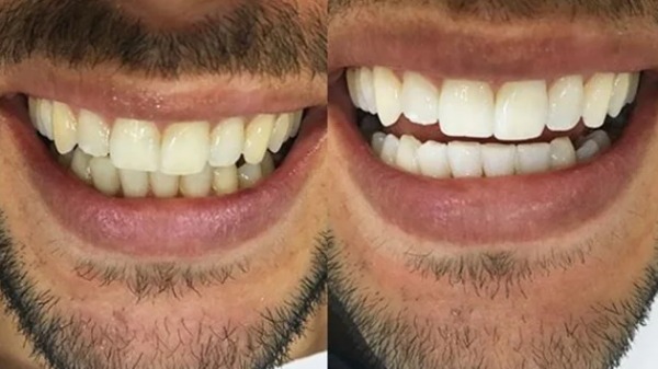Clareamentos dentários têm se tornado cada vez mais comuns no Brasil, mas o procedimento é seguro?