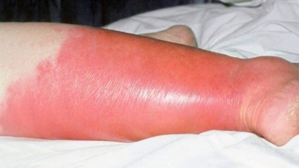 Você já ouviu falar da erisipela? Inflamação na pele é causada por uma bactéria e geralmente dá nas pernas