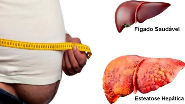 Gordura no fígado - Foto: Divulgação
