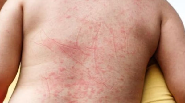 Você sabe quais são as causas das manchas na pele em casos de dengue?