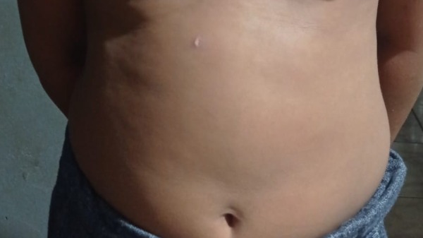 Família denuncia falta de ação da escola após menino de 10 anos ser queimado com isqueiro - Foto: Arquivo pessoal