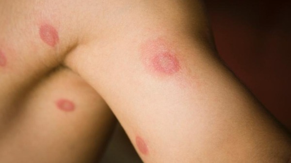 Micoses, impetigo, bicho geográfico... como evitar estas doenças de pele?