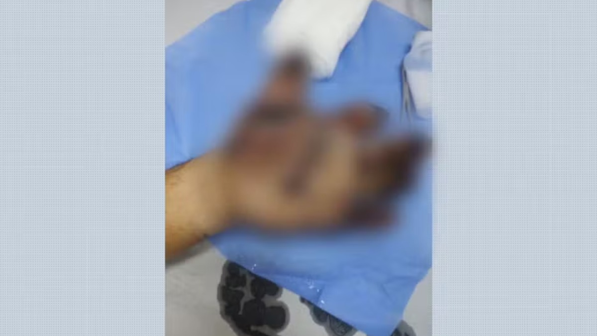 Pintor perde dedos da mão após bomba explodir durante trabalho em Barretos