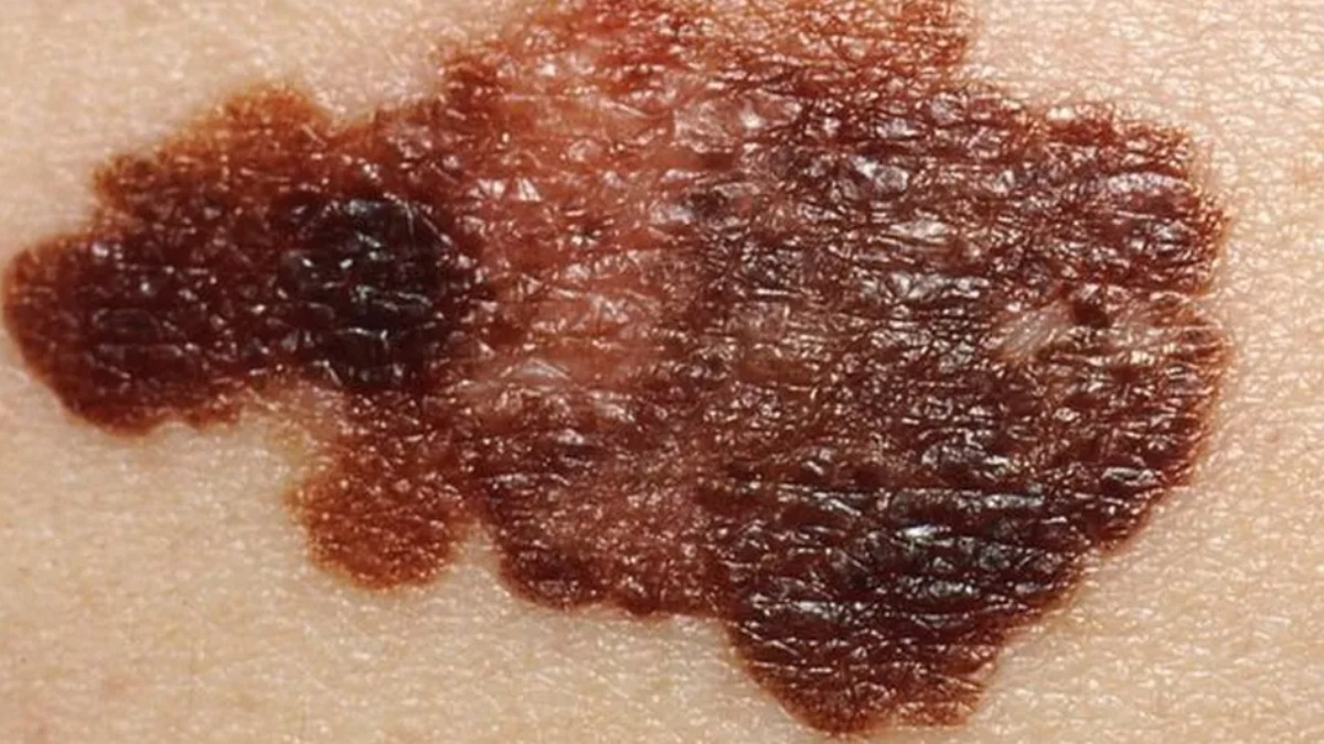 Calor, baixa umidade, radiação ultravioleta... como se proteger do câncer de pele?