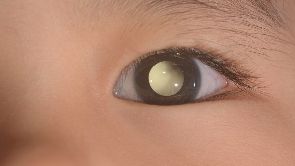 PodFalar, Mãe! #64 Retinoblastoma