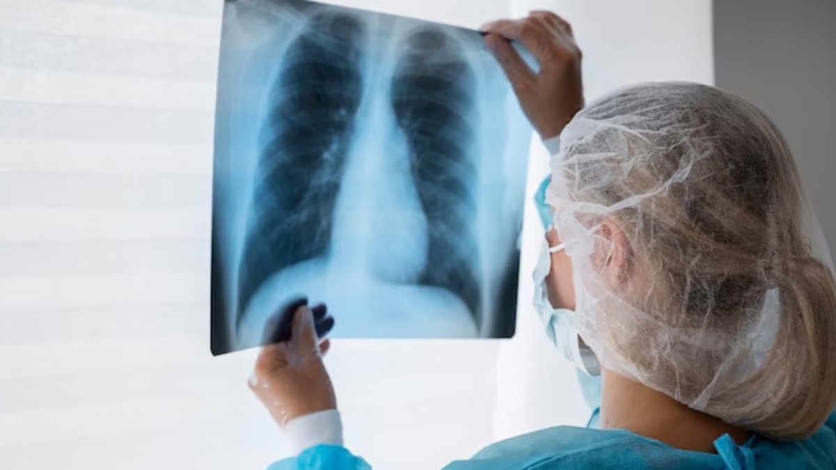 Nova terapia reduz em 46% a progressão do câncer de pulmão