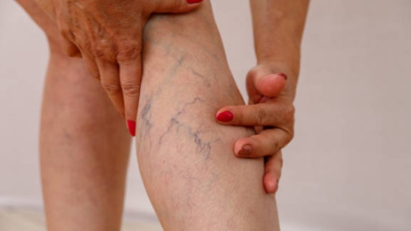 Tecnologia melhora procedimentos de cosmiatria vascular com tratamento acessível e efetivo