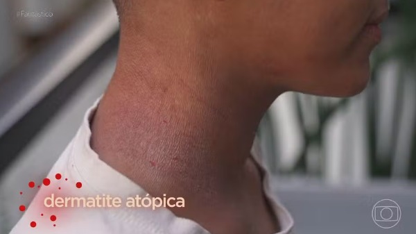 Você já ouviu falar na dermatite atópica?